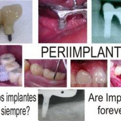 Enfermedades periimplantarias