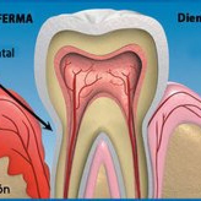 Diabetes y enfermedad periodontal
