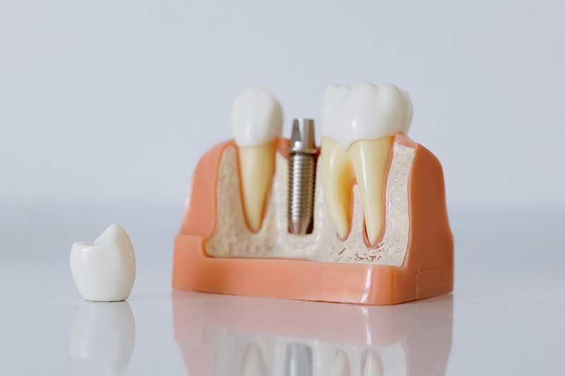 Implantes dentales Implantes dentales