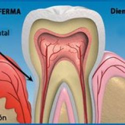 Diabetes y enfermedad periodontal