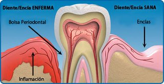 Diabetes y enfermedad periodontal