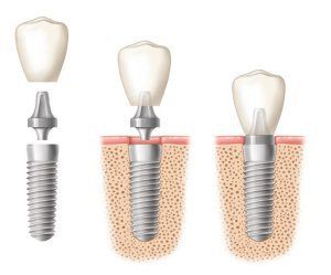 implantes dentales santander implantes dentales santander