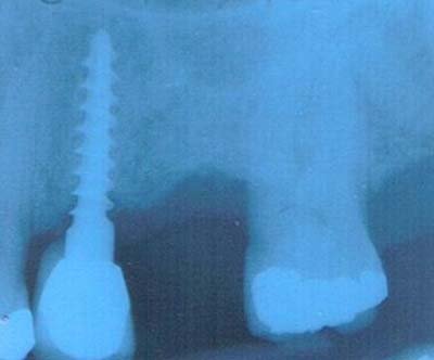 imagen de una radiografia que muestra un implante dental Radiogracia de implante dental en Santander