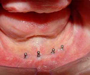 Caso de un tratamiento con implantes realizado en la clínica en Santander Imagen de un tratamiento con implantes realizado en Santander
