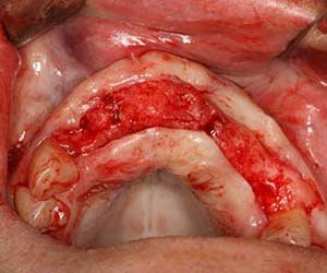 opciones de tratamiento con implantes opciones de tratamiento con implantes