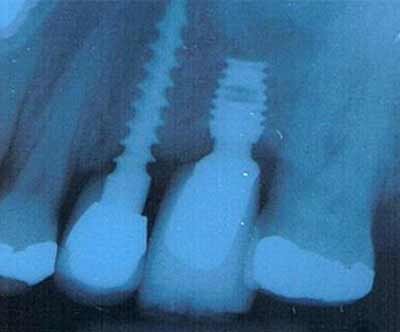 imagen de una radiografia que muestra dos implantes dental Radiografia de sdos implantes dentales realizados en la clínica en Santander
