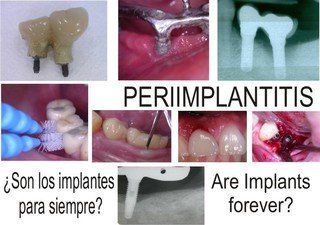 Enfermedades periimplantarias