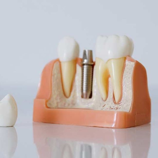 Implantes dentales