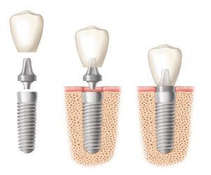 implantes dentales santander